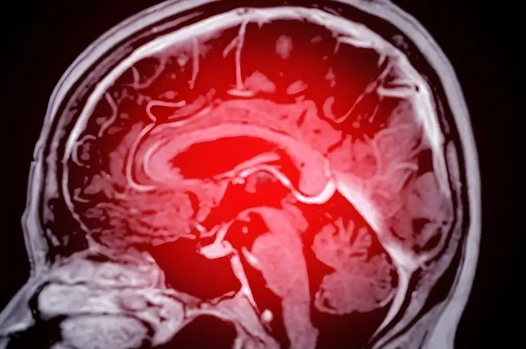 Brain scan image with a red highlighted injury area, accompanied by the Dennis Hernandez Injury Attorneys logo overlay.