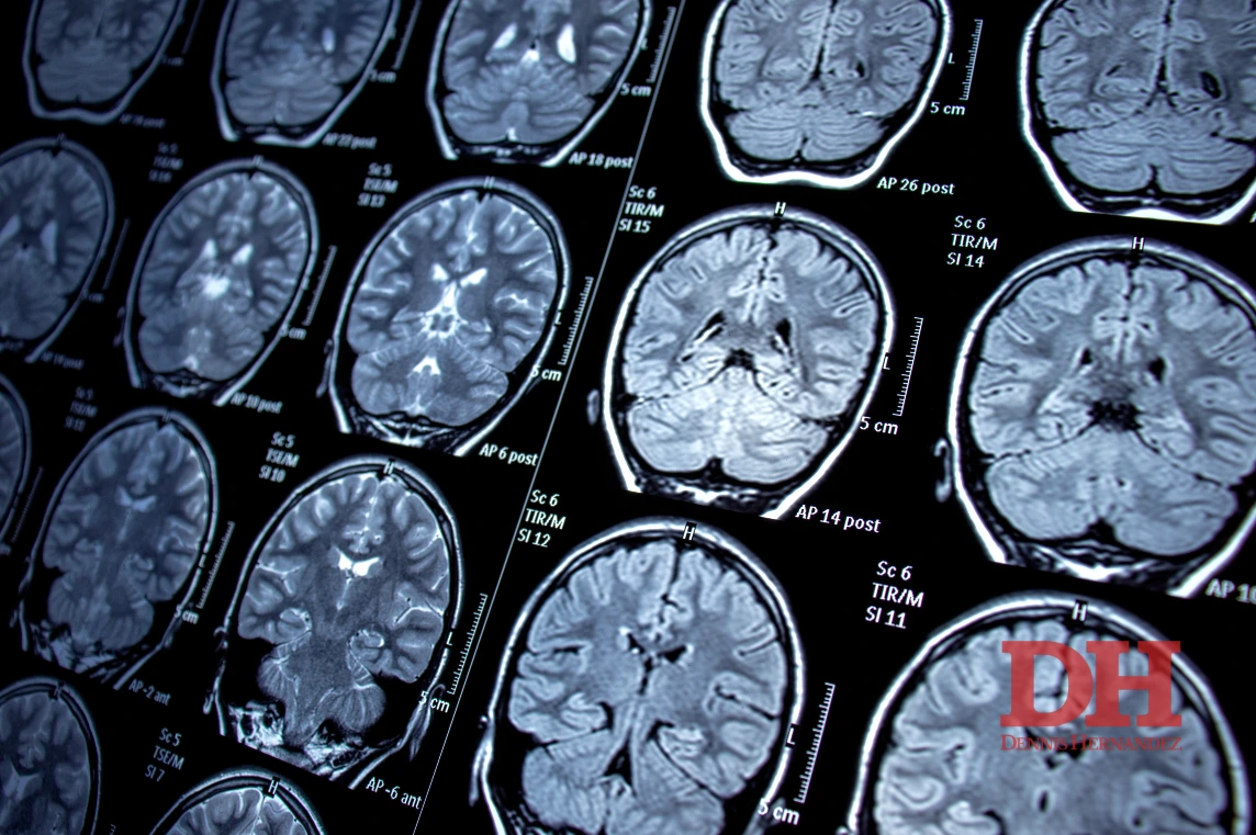 Series of brain MRI scans displayed in grayscale, showing multiple cross sections of the brain.