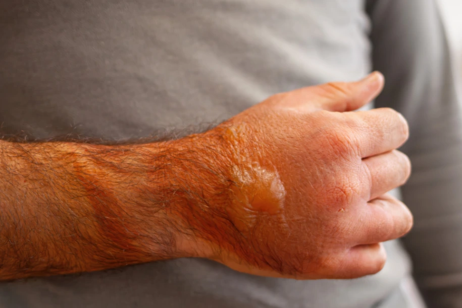 Close-up of a swollen and bruised wrist and hand showing signs of injury. Burn Injury