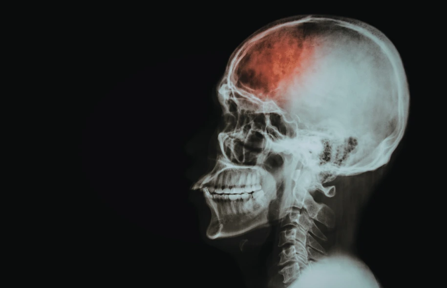 Side view X-ray image of a human skull with a highlighted area indicating brain trauma.